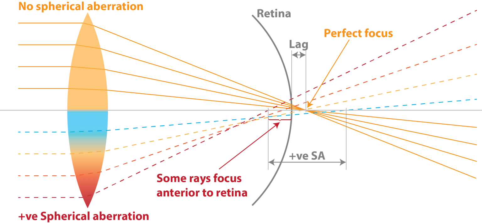 Understanding spherical aberration Myopia Profile