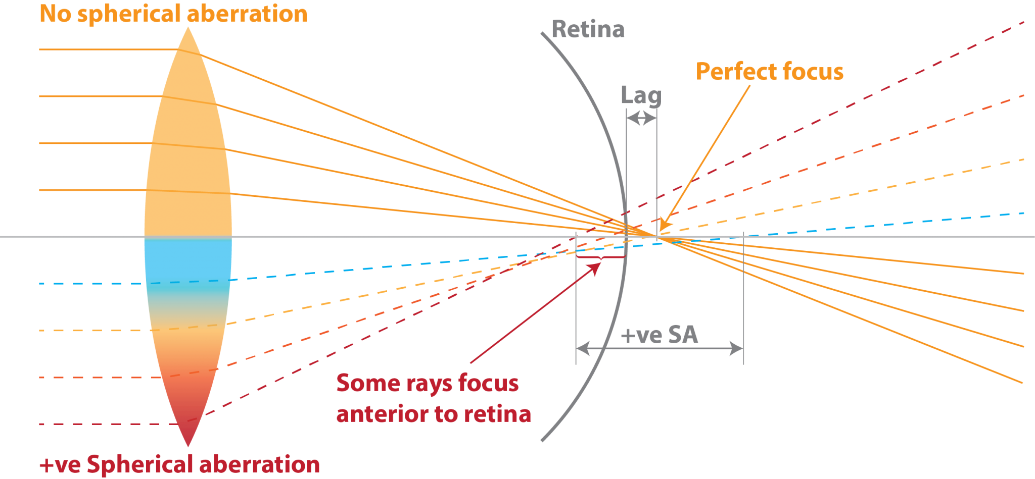 Understanding spherical aberration Myopia Profile