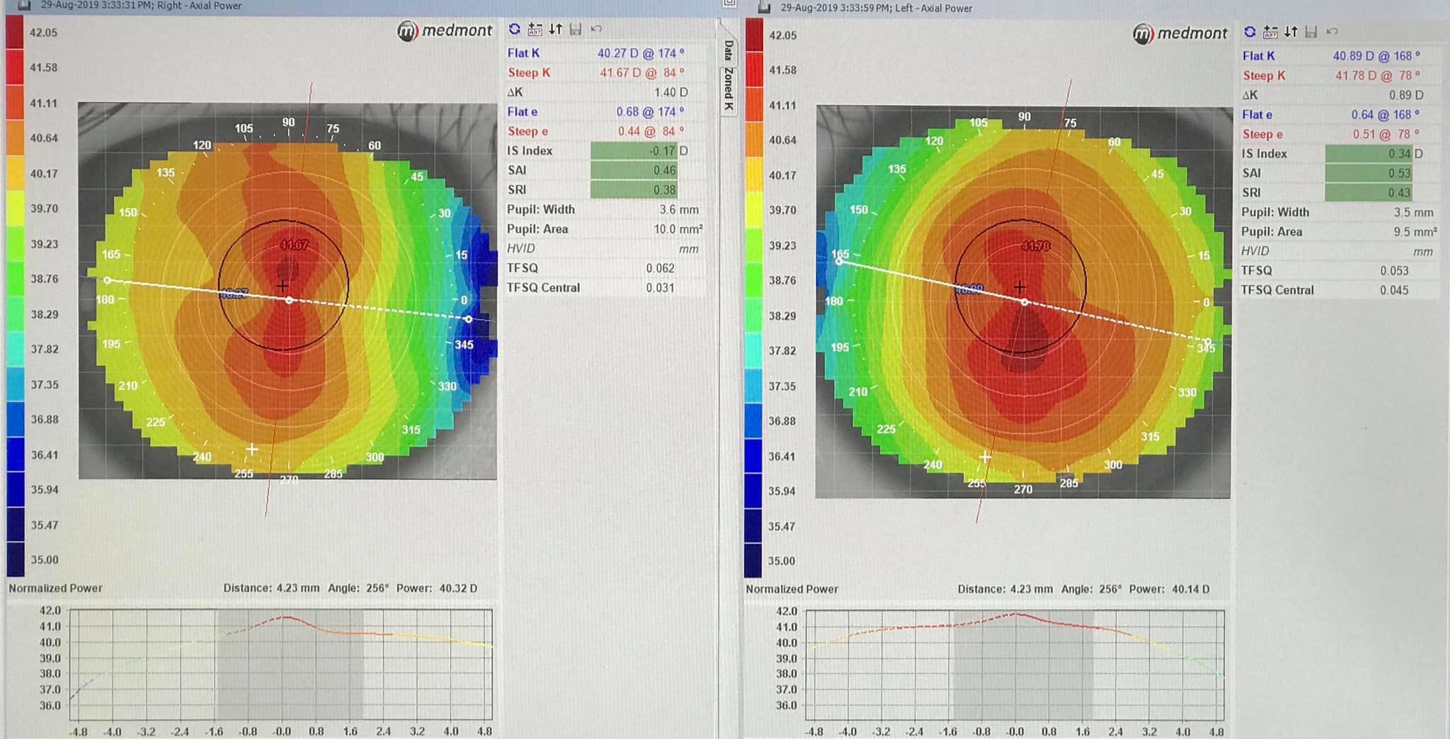 corneal topography